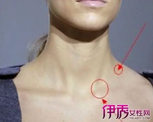 锁骨上淋巴结的临床表现