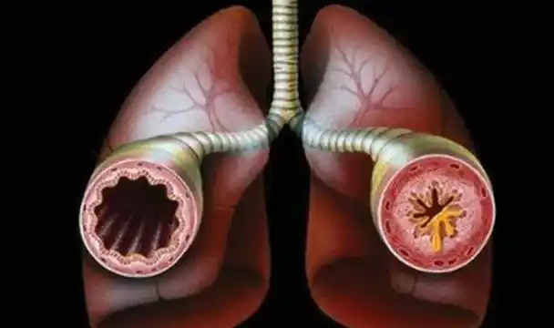 痰是肺部健康的信号,咳出黑痰,黄痰,白痰分别代表什么?要知晓