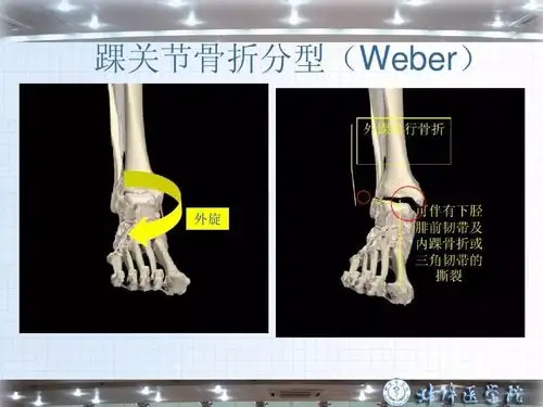 踝骨骨折护理查房