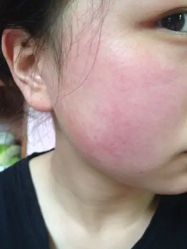 脸泛红 去医院检查得出是过敏性皮炎 觉得是自己吹热风的时间吹长了