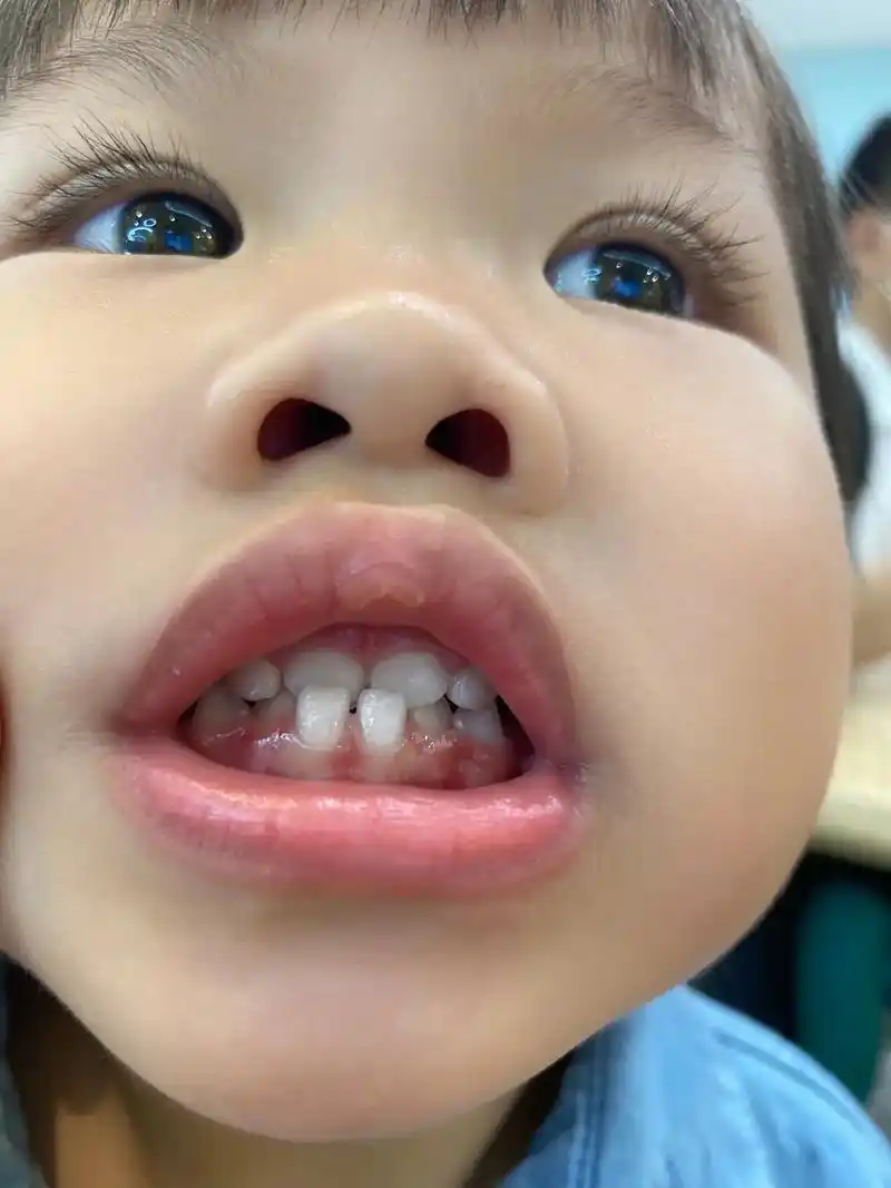 两岁八个月开启地包天矫正之旅.