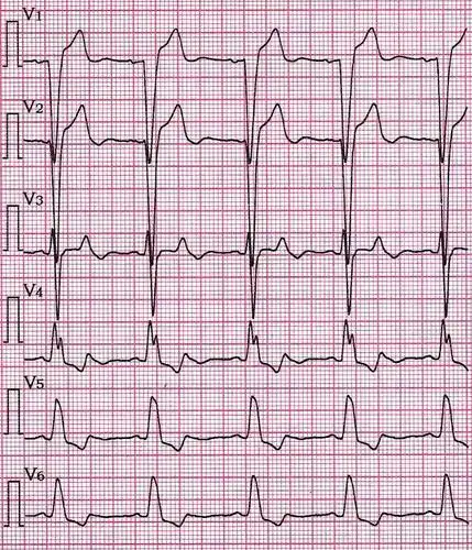 临床实用心电图入门第三十三讲室内传导阻滞(2)