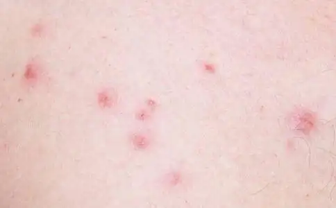 网友上传的真实艾滋病初期皮疹图片