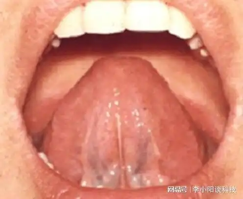 一旦身体出现了问题,那么舌下络脉也会随之发生改变.