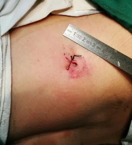 椎间孔镜微创手术,伤口长约1cm,号称钥匙孔手术.