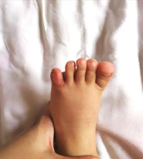 区人民医院骨三科成功开展小儿复杂型多趾并趾手术一例