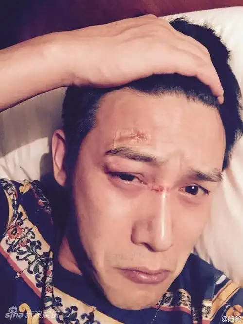 陆毅拍戏眼部受伤寻消肿法伤口不忍直视