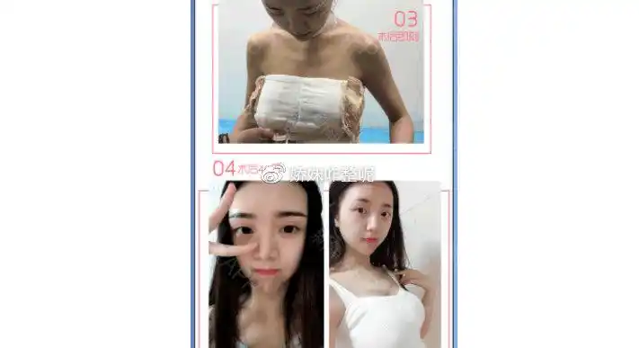 我用2万元做了曼托假体隆胸250cc,分享三个月变软的真实感受及经历