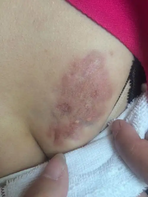 洗纹身论坛皮肤细胞阻断再生术去除胸口增生疤痕记录