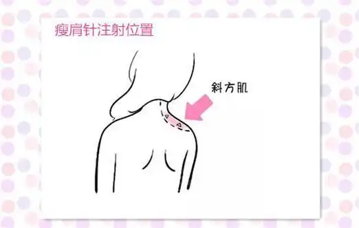 专家解析:瘦肩针真的有用吗?