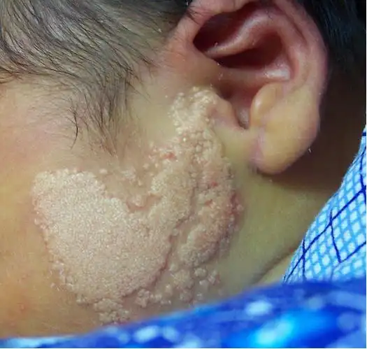 点赞 收藏 全部讨论(18) rjz_2004 12-14 22:50 皮脂腺痣最好在儿