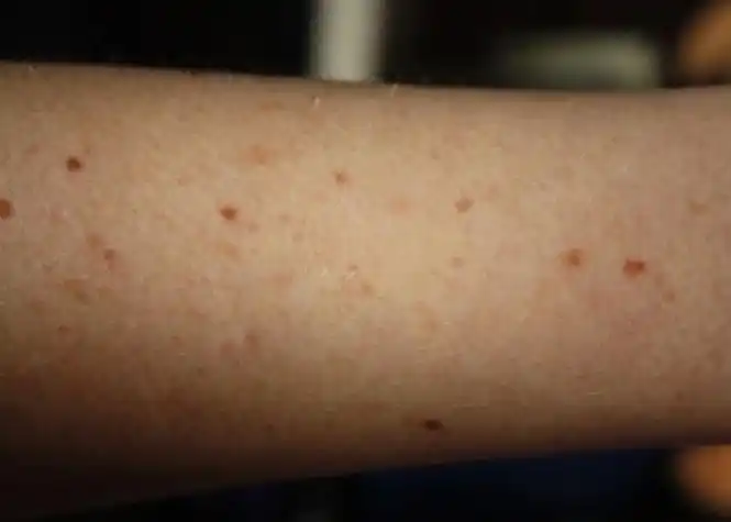 癌症早期皮肤症状图片_皮肤癌早期症状图片_癌症早期的图片