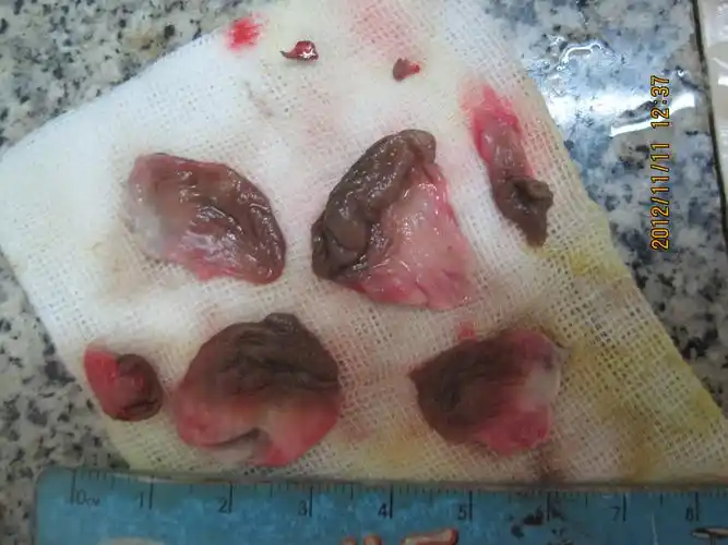 第四十三例环状静曲混合痔王女士术前术中术后图片集