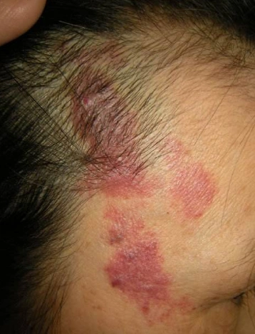 蜘蛛疮早期症状图片5