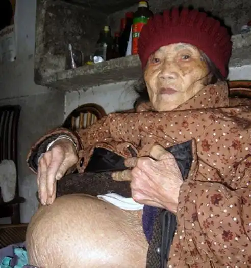 90岁高龄老人去医检查发现肚子里有58年的死胎