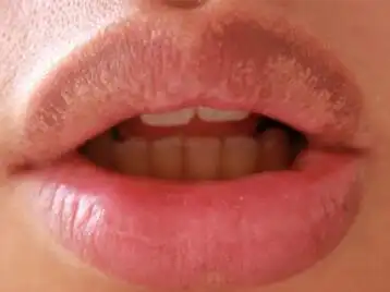 1,皮脂腺异位症