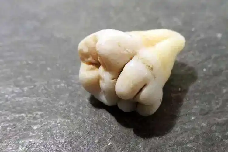 结合牙和融合牙的区别图解_有来医生