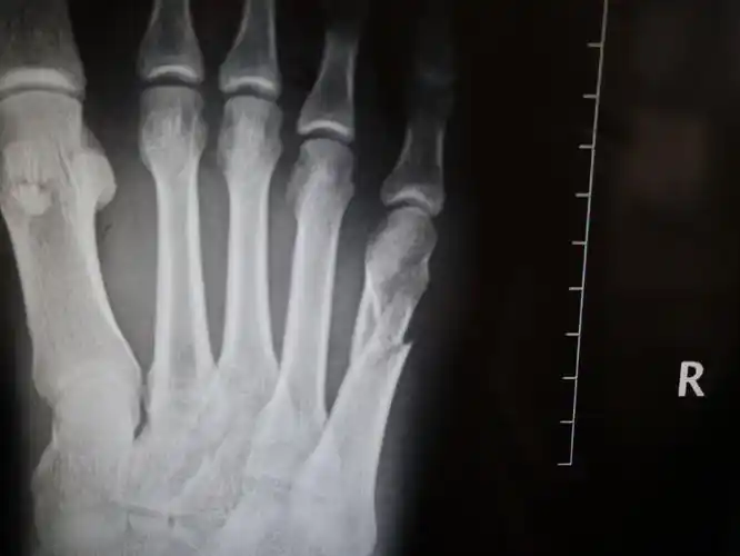 小脚趾骨折,请问这种情况算不算是骨折移位 不加钢针连接治疗会不会