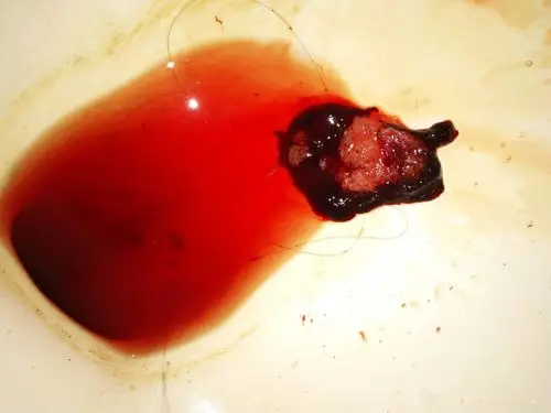 药流第三天出来这个是不是说明成功了,那个暗红色血块特别硬是为什么