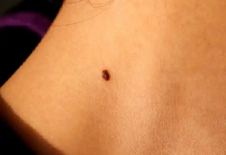 手背上黑色素瘤早期症状图片