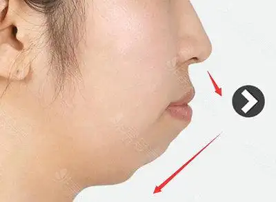 凸嘴和双鄂手术区别有哪些,韩国医院如何矫正?