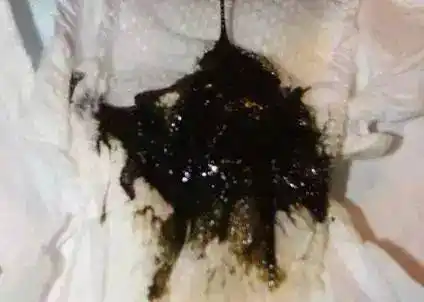 黑便,绿便,泡沫便,蛋花便,奶瓣便究竟是怎么回事?