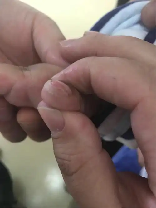 永城市中心医院/儿童医院临床医学部再次成功救治一例川崎病患儿