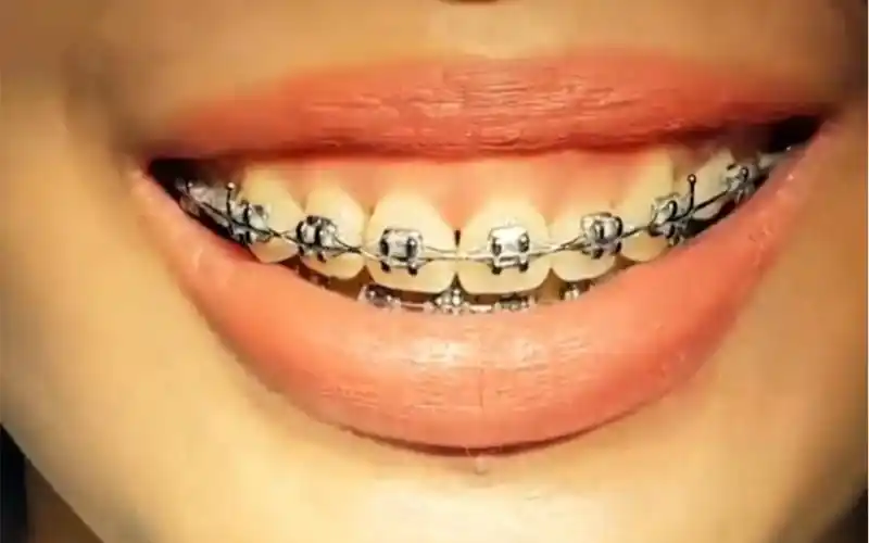 来看看牙套咋戴上的,传统的结扎钢丝 ,已经用橡胶圈代替了.