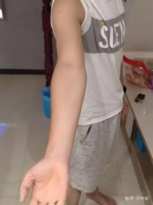 我想问一下我的这个算肘外翻吗?军检有没有问题?