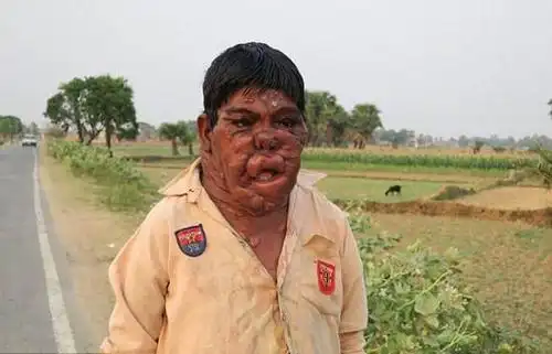 印度幽灵男孩患罕见疾病面部与身体布满肿瘤