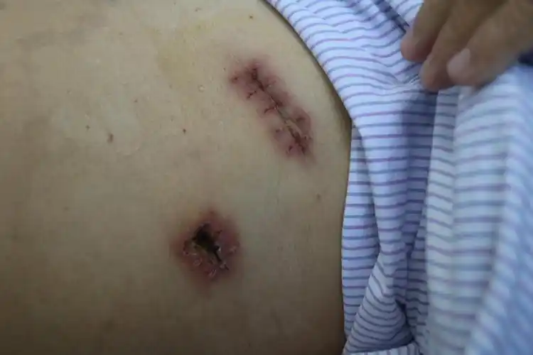 胸腔镜让肺部肿瘤无处遁形海南西部中心医院胸外科肺癌治疗新方法深受