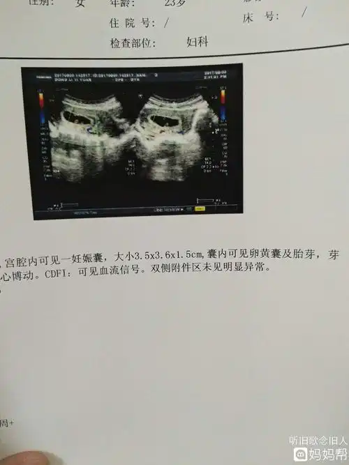 2,孕囊大小看男女99%准确对照表 喜脉之脉为滑脉按之流利,圆滑如按