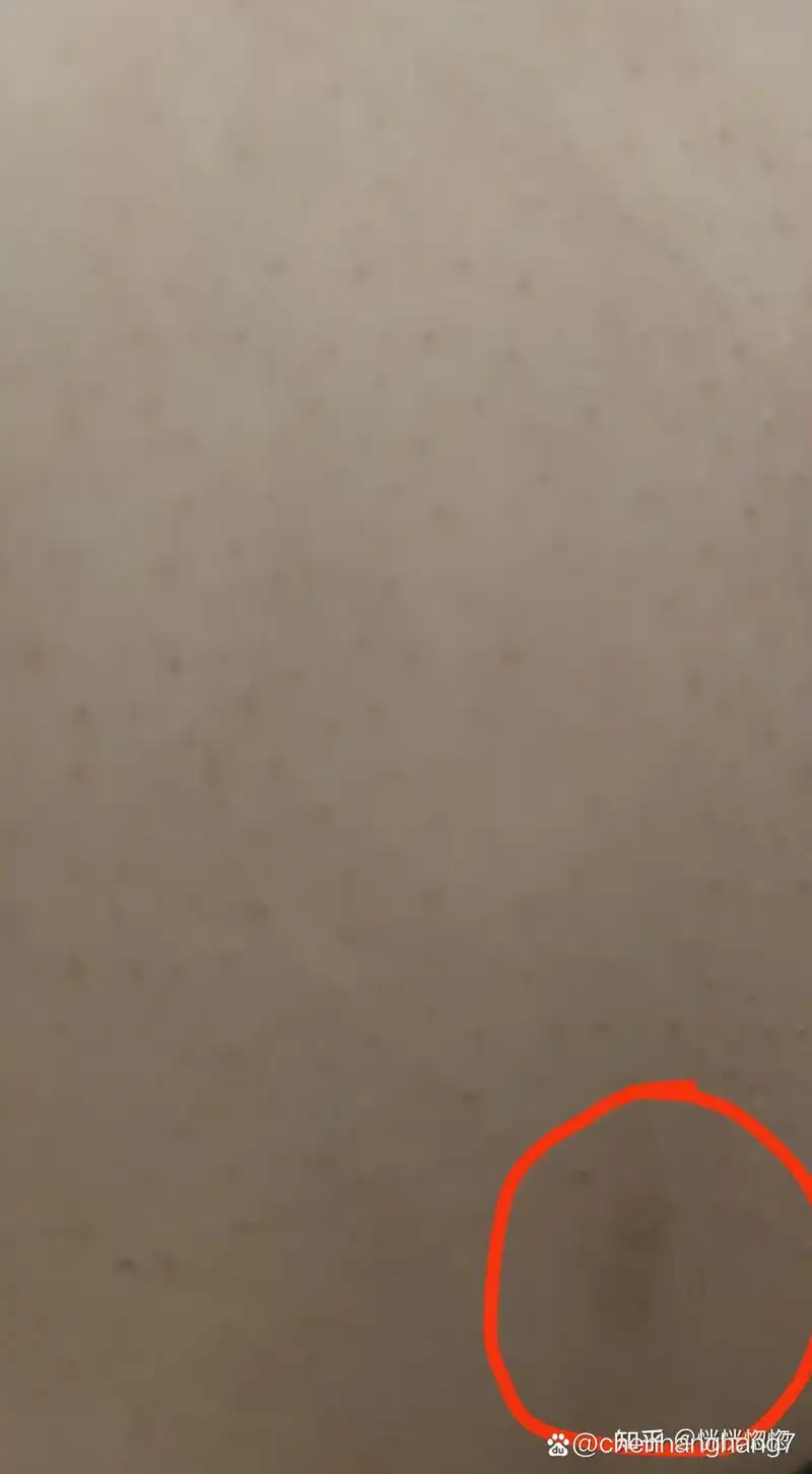 肚子上的棕色斑点是什么