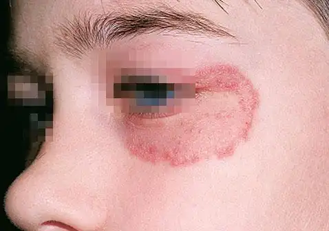 面部长癣是什么样子的面癣的治疗症状图片