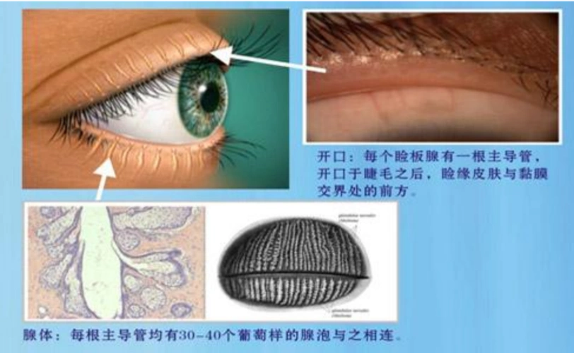 睑板腺功能障碍是怎样引起干眼的