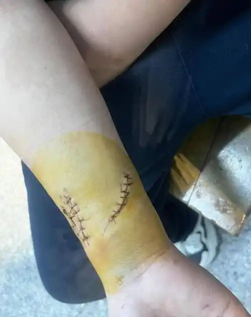 学生在托管打闹受伤,手臂被割处两个大口子缝合近二