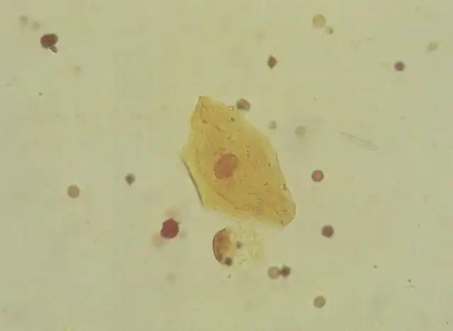 犬尿沉渣中的鳞状上皮细胞