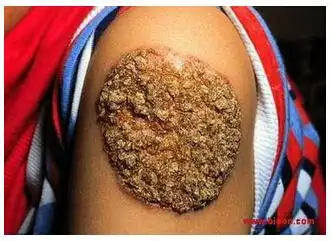 皮肤肉芽肿的症状,皮肤肉芽肿怎么办,皮肤肉芽肿护理_引起原因_百姓