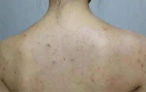 芒种后后背痘痘不断多半躲毛囊里的螨虫往外打洞要爬出来