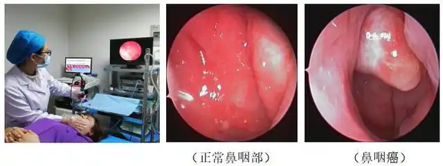 以地名命名的恶性肿瘤——鼻咽癌(广东瘤),不容小觑