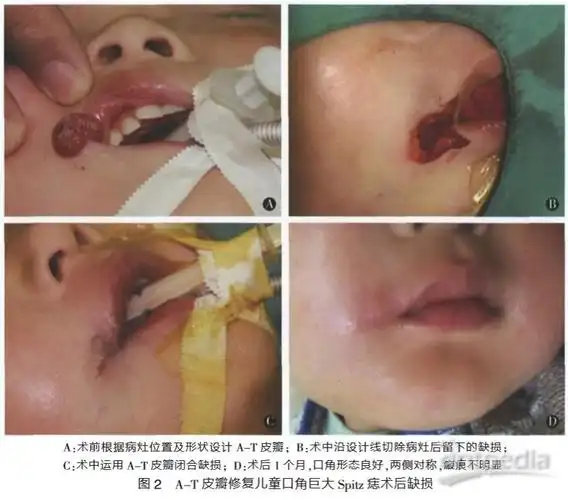 运用at皮瓣治疗儿童口角巨大spitz痣病例分析