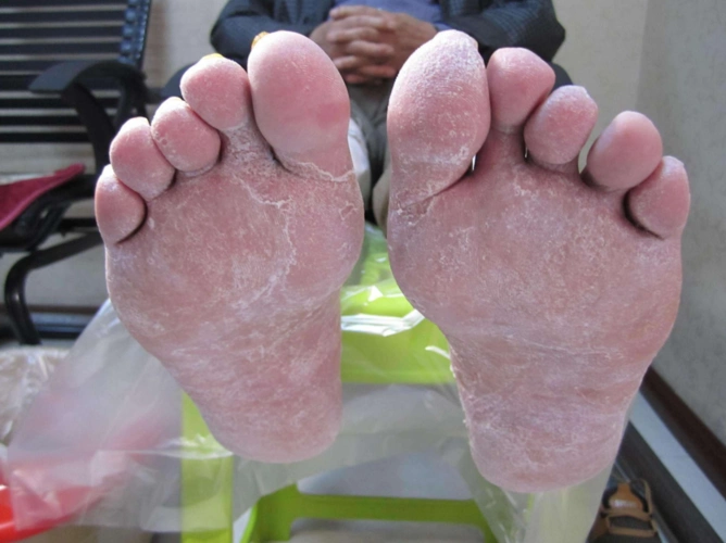手藓足藓症状图片_有来医生