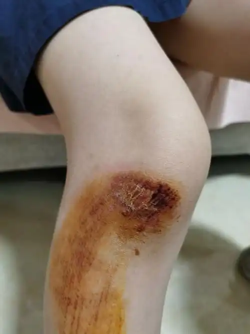 膝盖擦伤20200502