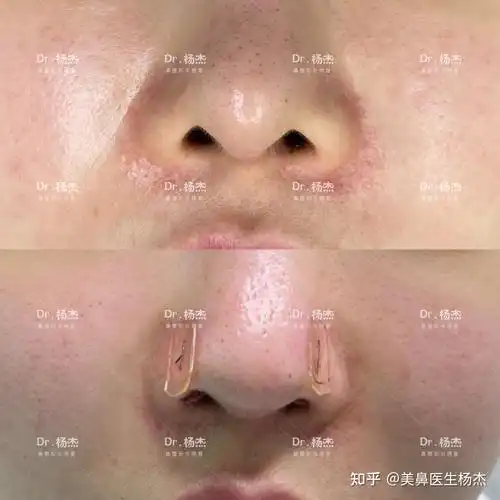 漏鼻孔鼻翼缘退缩修复