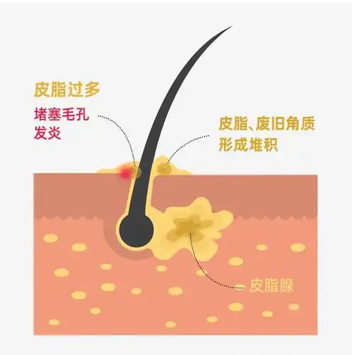 头皮油的本质:皮脂腺油脂分泌过多.