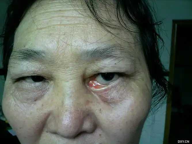 【讨论】少见的下睑外翻