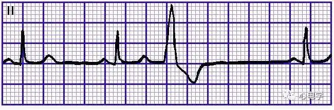 室性早搏的心电图基本特征|窦性|心室_网易订阅