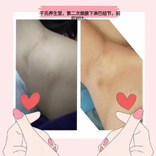 腋下淋巴结,效果极佳.