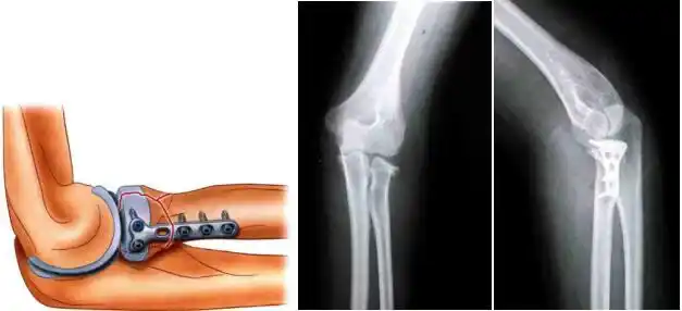 显著向背侧突出;肘关节外翻不稳定提示切除桡骨头后的慢性essex-lopr