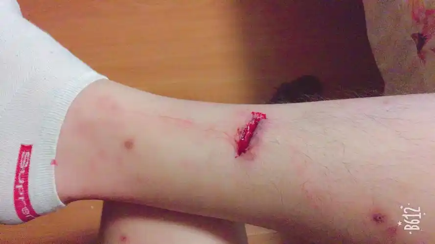 腿划破,蛮深的,缝了五针,可以正常走路.